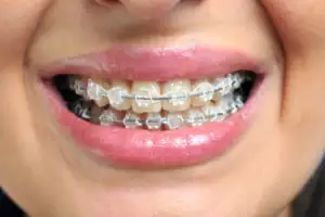 Clear Braces