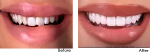 Porcelain Dental Veneers before after