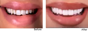 Dental Veneers Porcelain Dental Veneers before after