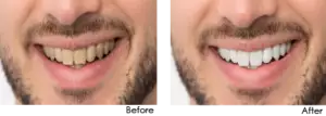 Smile makeover Smile Makeover Treatment