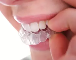 Invisalign