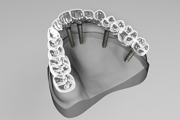 What are Dental Implants dental implants