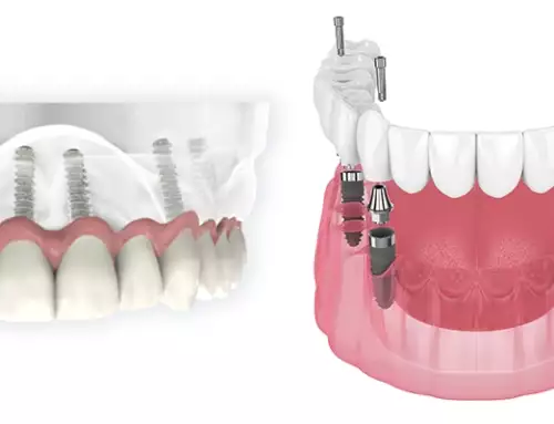 All-on-4 vs. All-on-6 : Which is Best for You?