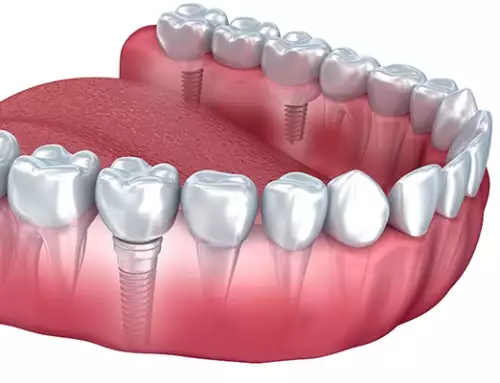 Cost of Full Mouth Dental Implants