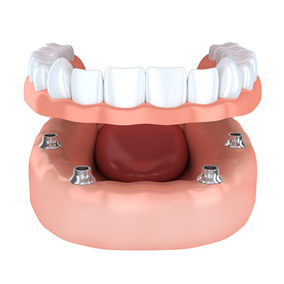 snap- in dentures