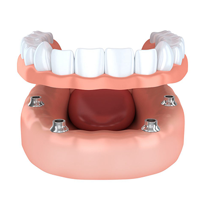 Costs For Dental Implants Margate Florida