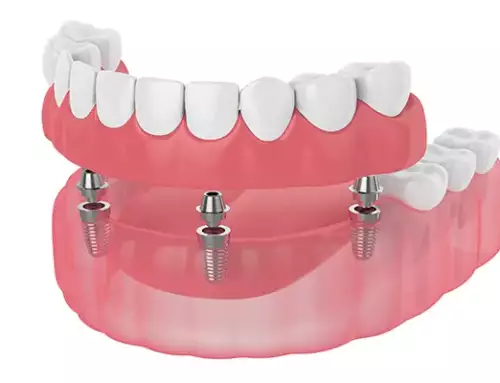 How Much Do Snap-In Denture Implants Cost In Margate, FL?