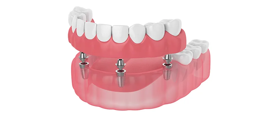 Costs For Dental Implants Margate Florida