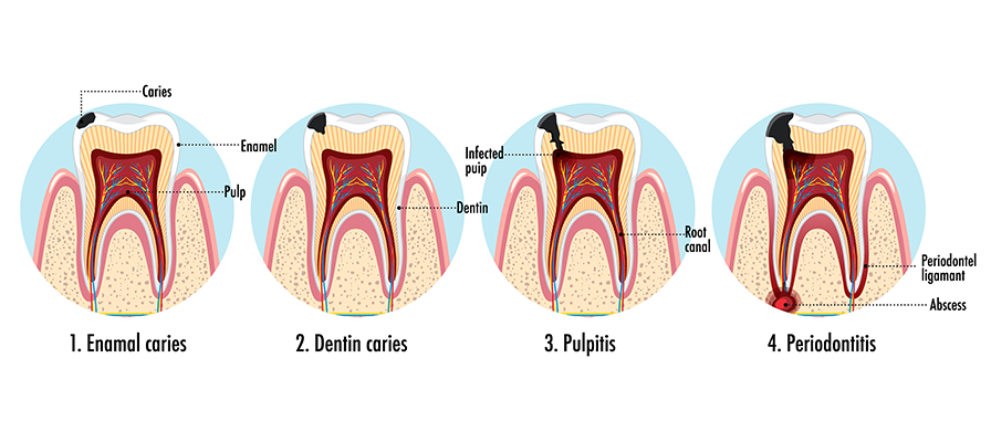 Tooth Decay And Abscesses