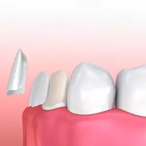 How often do veneers need to be replaced