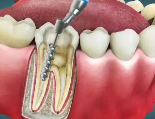 3 Stages Of Root Canal Treatment?