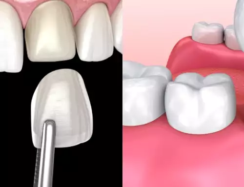 Dental Veneers vs Dental Crowns: All You Need to Know